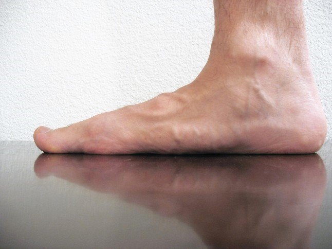 sindrome de pie plano adolescentes